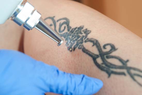 What are the different home tattoo removal methods