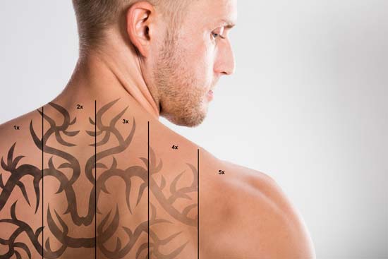 home tattoo removal methods