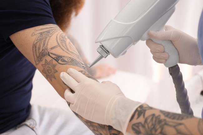 home tattoo removal