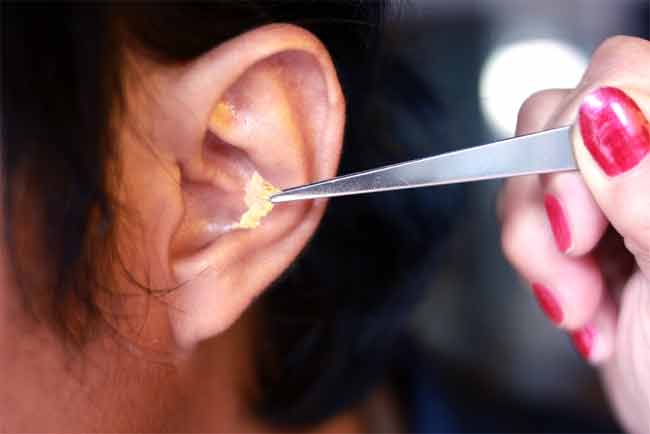 How Much does it Cost to get Earwax Removed
