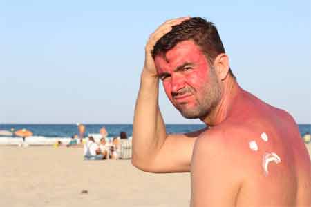Relieve Sunburn Pain