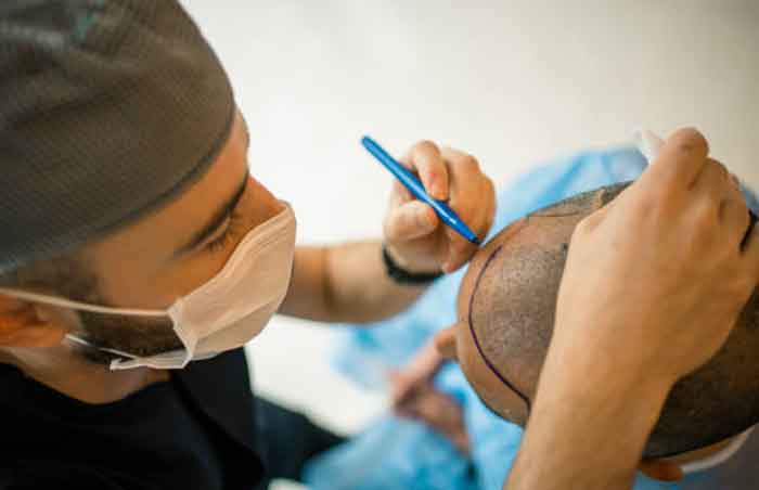 A Comprehensive Guide to the Hair Transplant Process