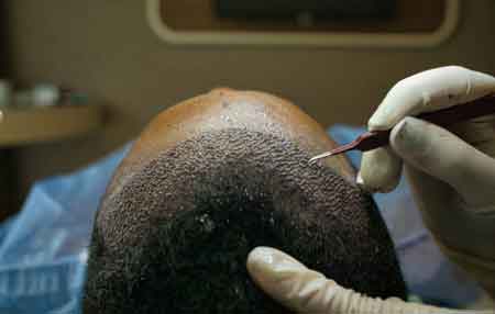 What is Involved in a Hair Transplant